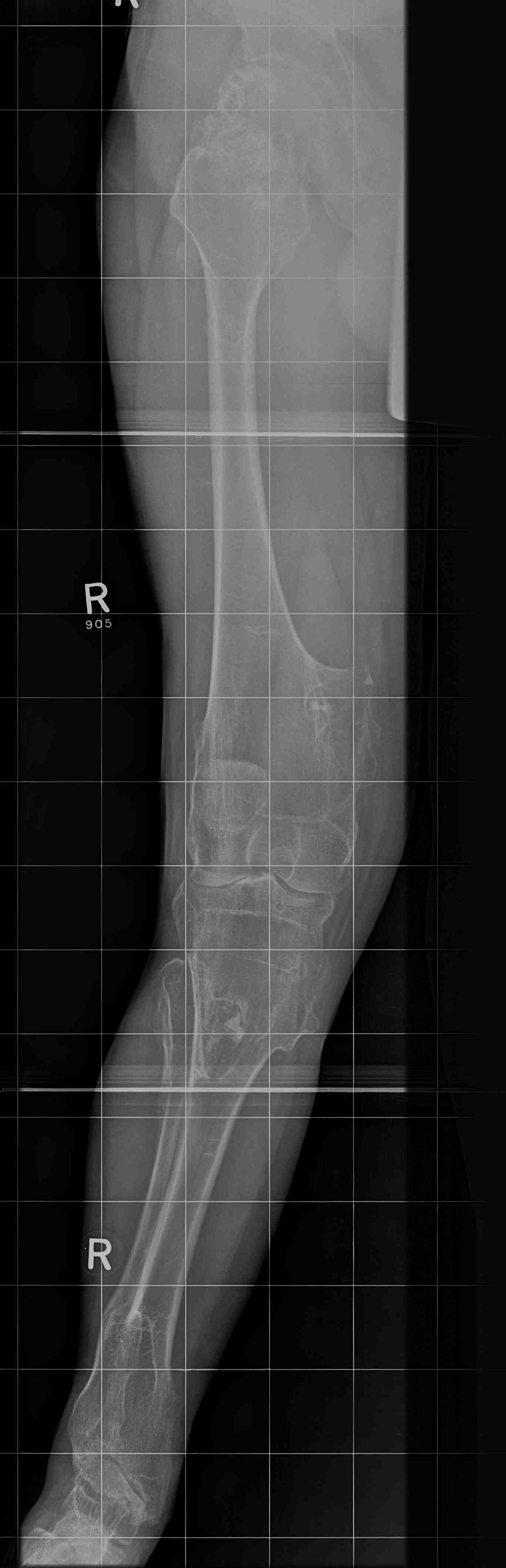 Osteochondromas Valgus Knee